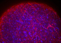 Sclerosi multipla, una molecola aiuta a riparare il sistema nervoso