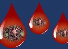 Alzheimer, verso la diagnosi da una goccia di sangue