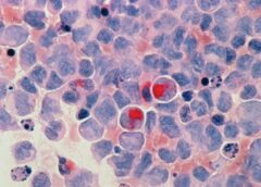 Le cellule tumorali diventano più aggressive se sono compresse