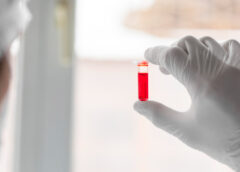 Usa la luce il sensore che vede nel sangue le prime spie di un tumore