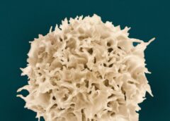 Cellule ribelli legano il virus di Epstein-Barr alla sclerosi multipla